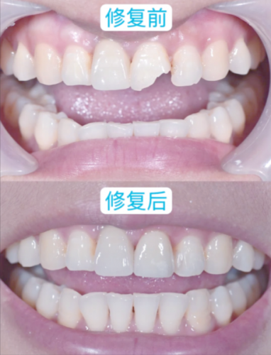牙齿修复，氧化锆全瓷如换真牙一般契合人类